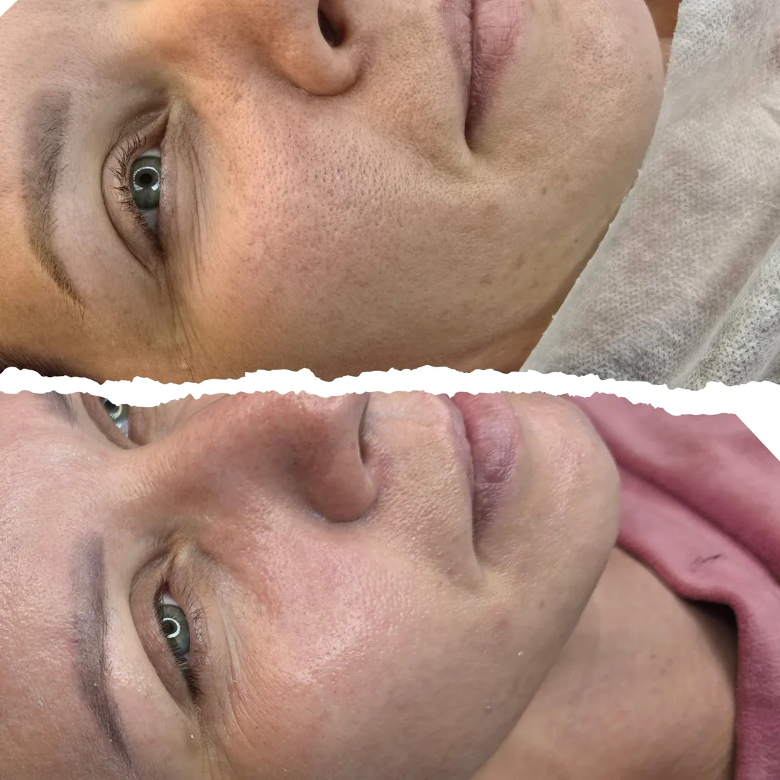 Laserowy peeling węglowy, skóra przed zabiegiem i po zabiegu, Puszczykowo
