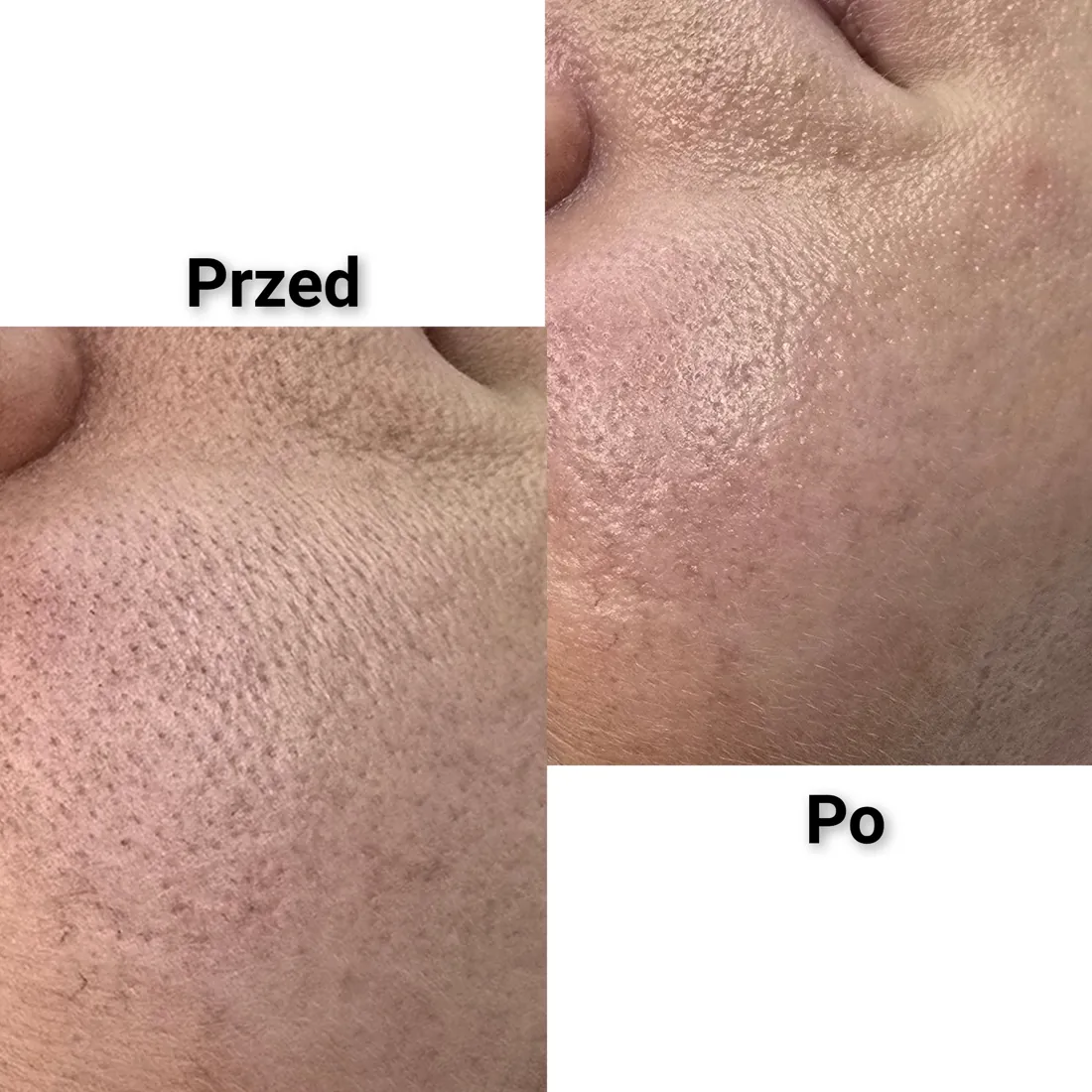 Laserowy peeling węglowy, skóra przed zabiegiem i po zabiegu, Puszczykowo