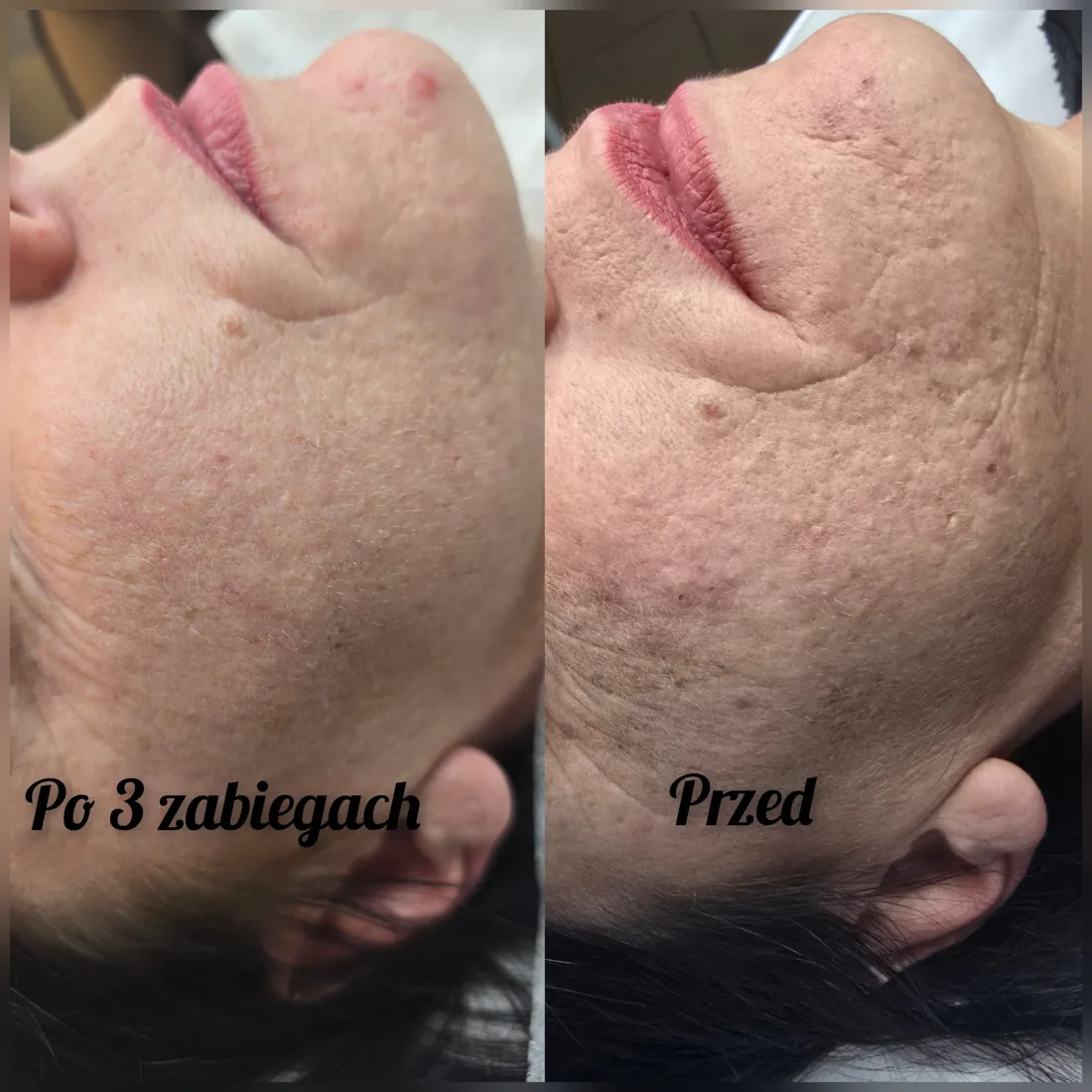Laserowy peeling węglowy, skóra przed zabiegiem i po zabiegu, Puszczykowo